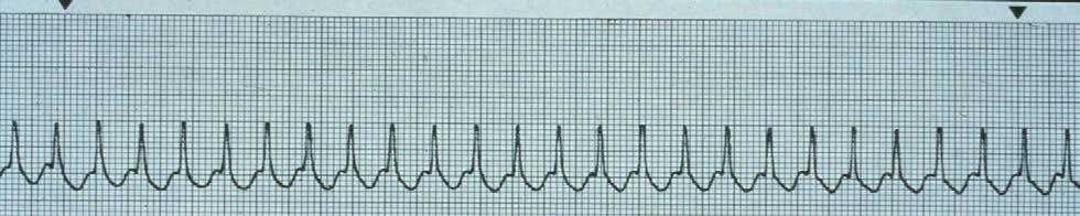 NWC EMSS CE Credit Questions Page 6 27. Which of these is indicated first for a stable pt in the above rhythm (HR 190) to slow the rhythm? A. Verapamil B. Adenocard C. Cardioversion D.