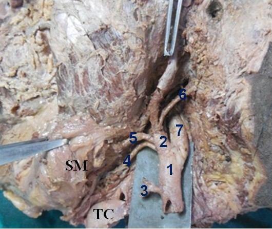 Fig. 3: Showing linguo-facial trunk arising from ECA on the left side. Fig. 6: Showing origin of STA from the anterior aspect of CB on the left side.