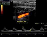 No diastolic flow Right ICA: Normal waveforms and