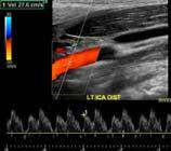 CCA, ICA and vertebral arteries Waveform has 2 peaks, one