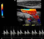 reversal at end diastole (arrow) Intra-aortic balloon pump
