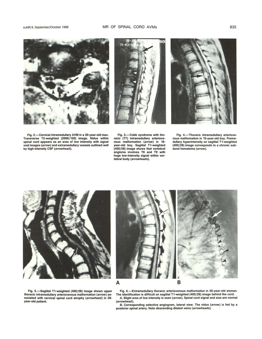AJNR :9. September/October 1988 MR OF SPINAL CORD AVMs 835 Fig. 2.-Cervical intramedullary AVM in a 30-year-old man. Transverse T2-weighted (2000/120) image.