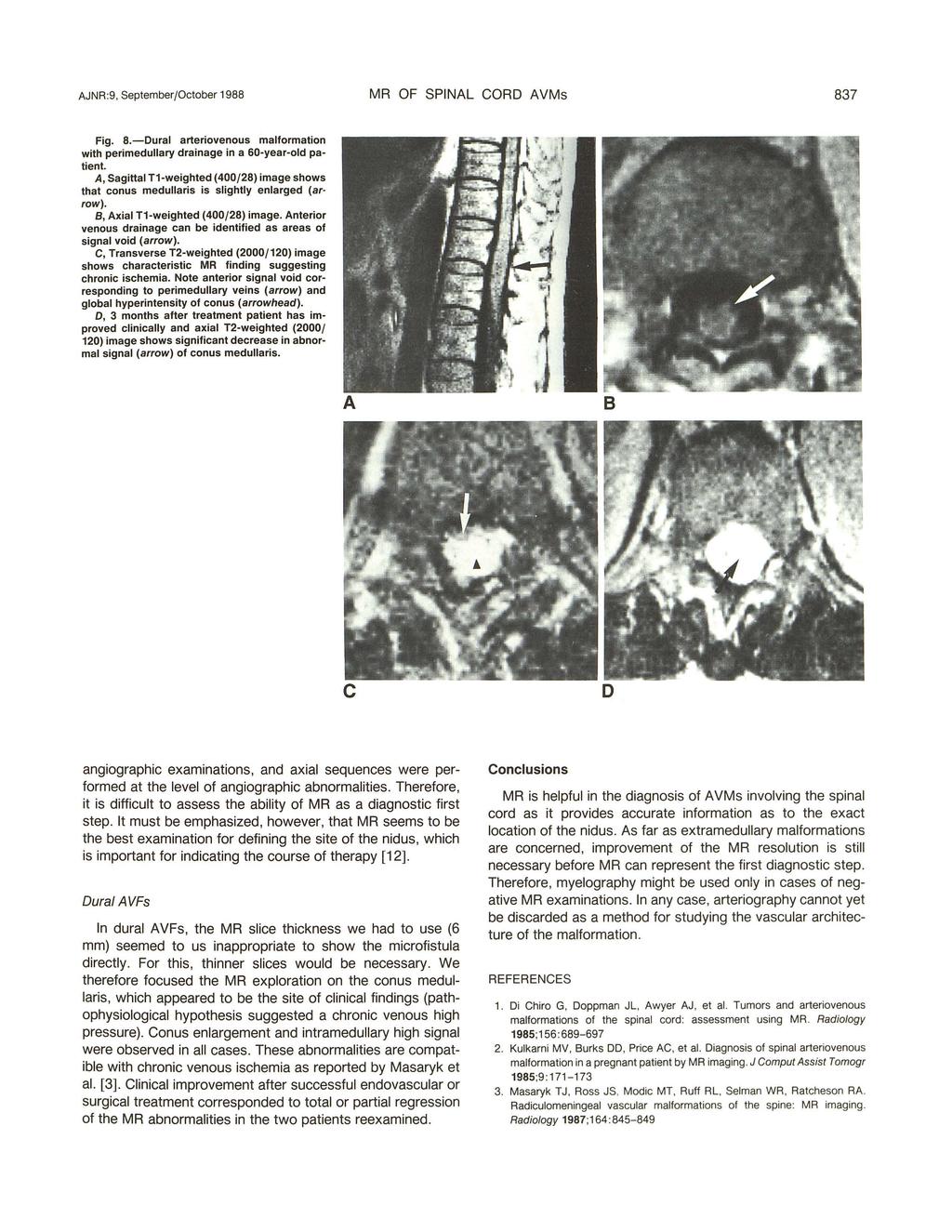 AJNR :9, September/October 1988 MR OF SPINAL CORD AVMs 837 Fig. 8.-Dural arteriovenous malformation with peri medullary drainage in a 60-year-old patient.