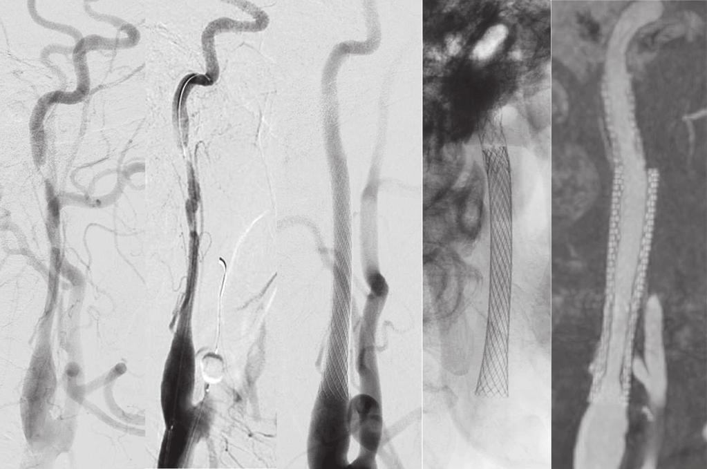 Two Cases of CAS Combined Balloon- and Self-Expanding Stent A B C D E Fig. 2 ( A) The preoperative left common carotid angiogram (lateral view).