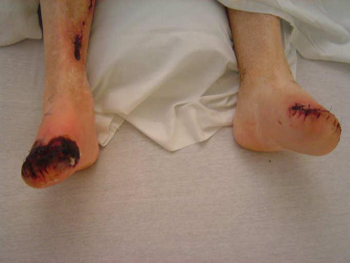 Forefoot and heel gangrene