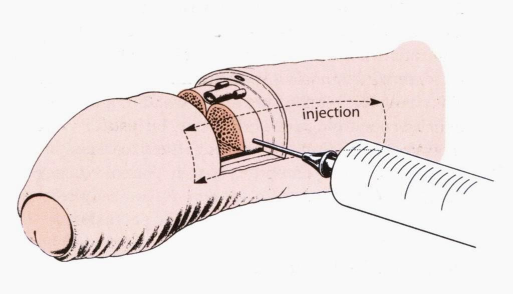 ERECTILE DYSFUNCTION: Technique of intracavernosal injection The intracavernosal application of vasoactive substances (phentolamine, papaverine, PGE1) becomes established for diagnostic