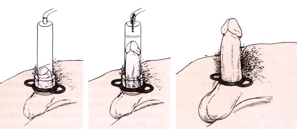 ERECTILE DYSFUNCTION: Principle of vacuum devices The devices consist of a plastic cylinder which is placed over the penis.
