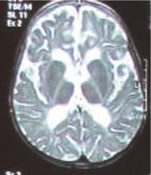 PMD is usually suspected by the presence of typical neurological findings in physical examination and abnormal myelination in Magnetic Resonance Imaging (MRI).
