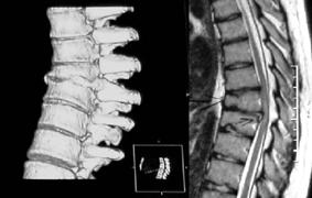 Obrázok 5. MR vyšetrenie dolnej časti Th chrbtice (vpravo) a CT 3D rekonštrukcia toho istého segmentu (vľavo) šom postupe liečby, resp. spôsobe operačnej liečby.