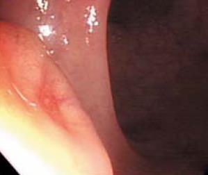 Endoscopical findings of rectal NETs Typical
