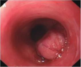 Esophageal NETs Rare NETs that account around 1.