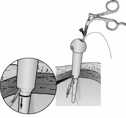 Instrumentation Laparoscopes Fascial Closure System for visualized full-thickness closure of trocar defects