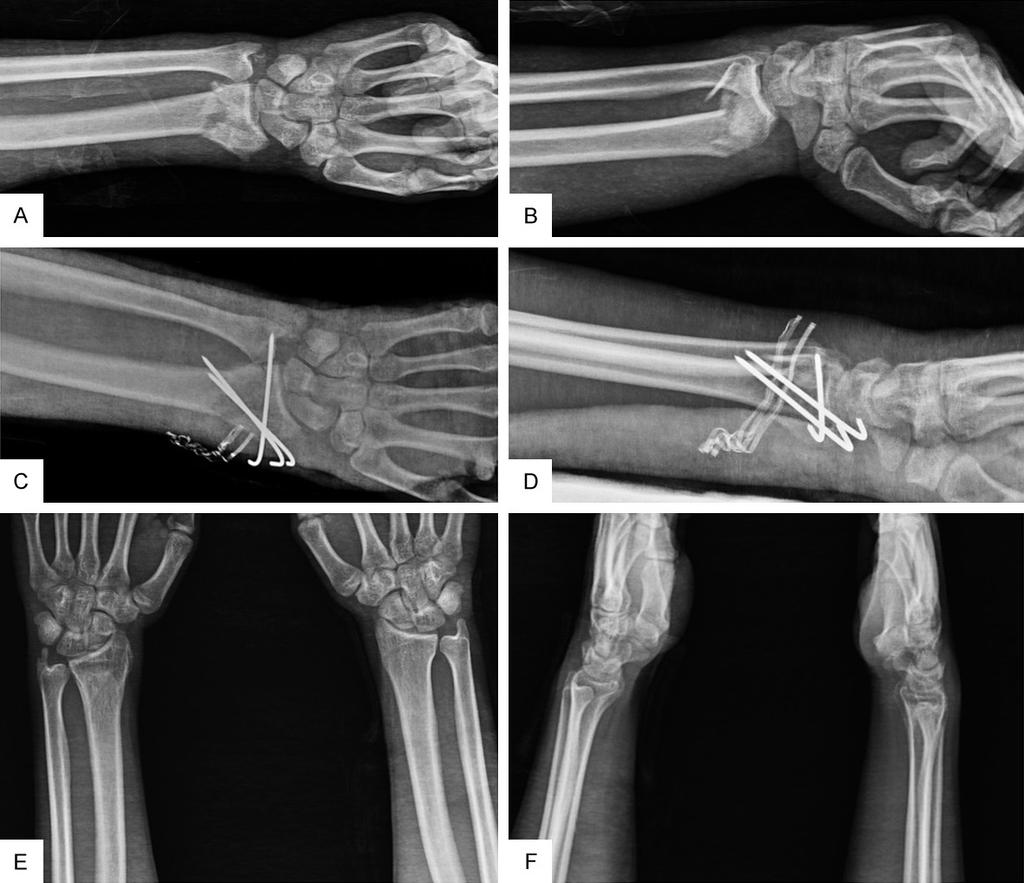 Figure 2. Comparative radiographs (with contralateral site) of patient with AO type C1 distal radius fracture of the left side. A, B. Images taken during the preoperative period. C, D.