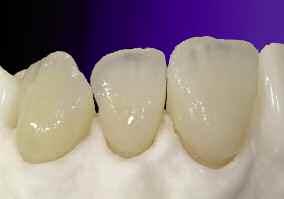 Crowns after the build-up of the first dentine layer For extended restorations, solid bridge elements or several small units, the