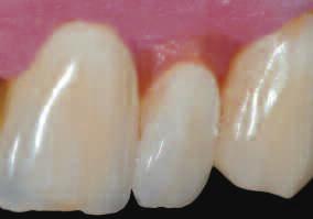 The ZIROX Gingiva materials Area of application With their variety of colors (5 differently shaded powders), the Gum Dentines may be used to accurately reproduce the exact color of the gingiva.