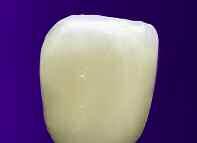 Bleach Dentines: The three Bleach Dentines differ mainly in their chroma: Bleach Dentine Light has the lowest color intensity and tends towards white.