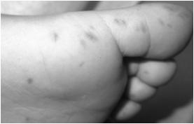 Molluscum contagiosum Etiology: pox virus Location: trunk & Variants: genital, perioral Incidence: 12-14 per 1000 children; highest among 1-4 yo 3 Prevalence: warm climate 4 ; rare in infancy, median