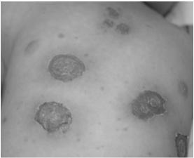 Case #5 1 year-old girl Flaccid bullae, followed by erythematous erosions w/ crust and scales Location: trunk, Bullous impetigo Etiology: Staph, Strep Types: primary, secondary Forms:» Non-bullous