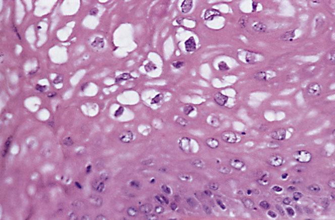J.Lešin, Doktorska disertacija 32 SLIKA 6. Koilociti Ovaj prikaz vrijedi za tipove HPV-a niske zloćudne sposobnosti.