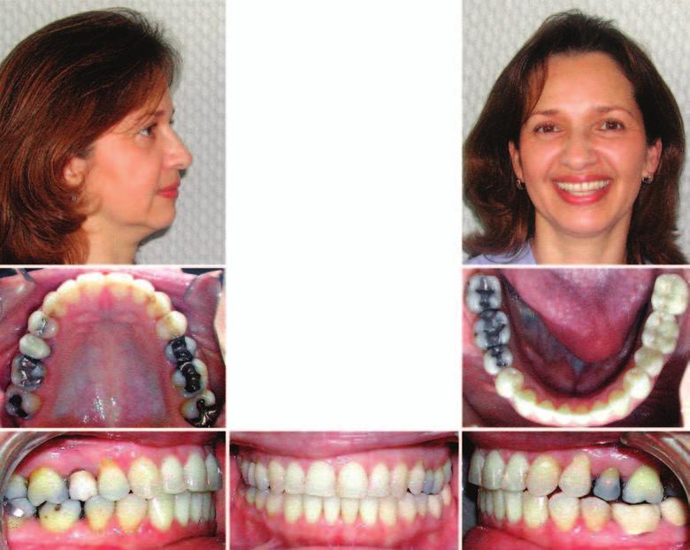 Patient now has cuspid and protrusive incisal guidance,