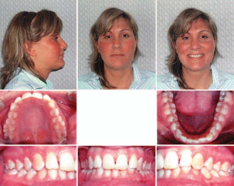 Summer 2006, v2 issue 1 Case 2: Extraction Figures 4a, 4b. This patient had a retained primary lower left cuspid (#M) which caused her lower midline to shift to the right.