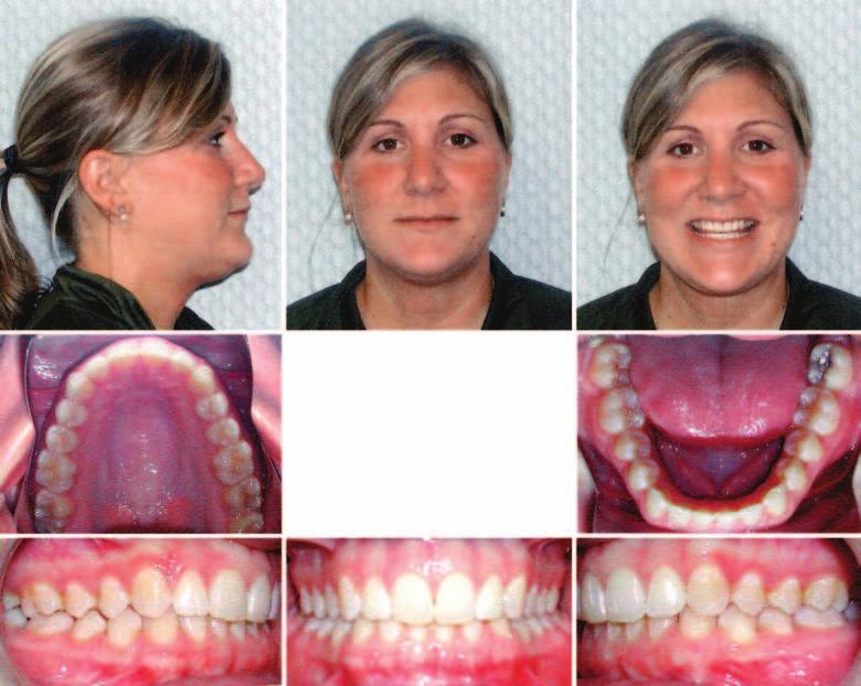 Summer 2006, v2 issue 1 Figures 6a, 6b. Attachments were bonded 10/04. Upper arch treatment took place at stages 8 26; 19 aligners total. Lower had 26 aligners in total.