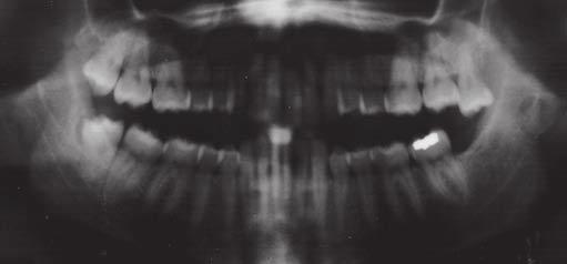 Note the root parallelism between the lower left lateral and incisor.