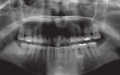 The second patient was a 17-year-old female unhappy with the spacing of her front teeth.