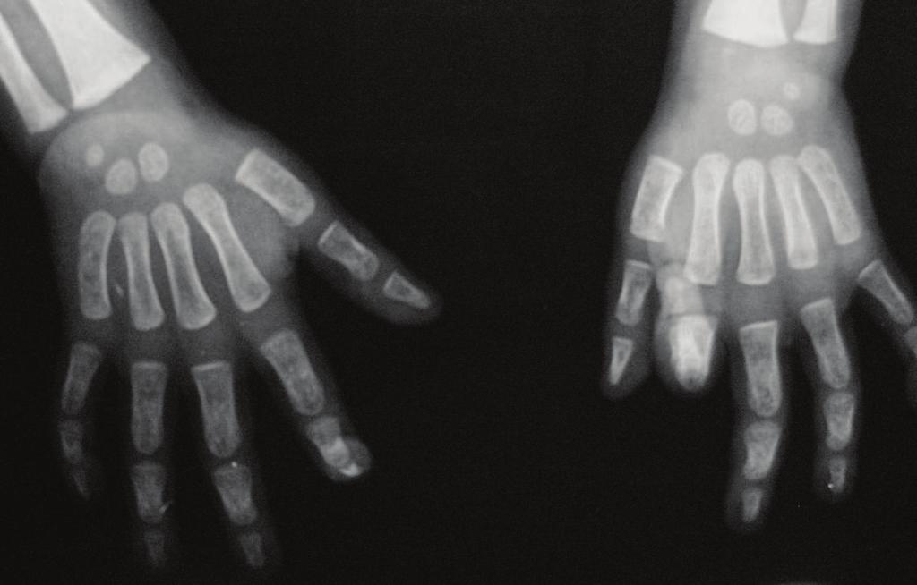 2 Case Reports in Infectious Diseases Figure 1: Plain radiographs showing little cortical hyperdensity of right hand fourth.