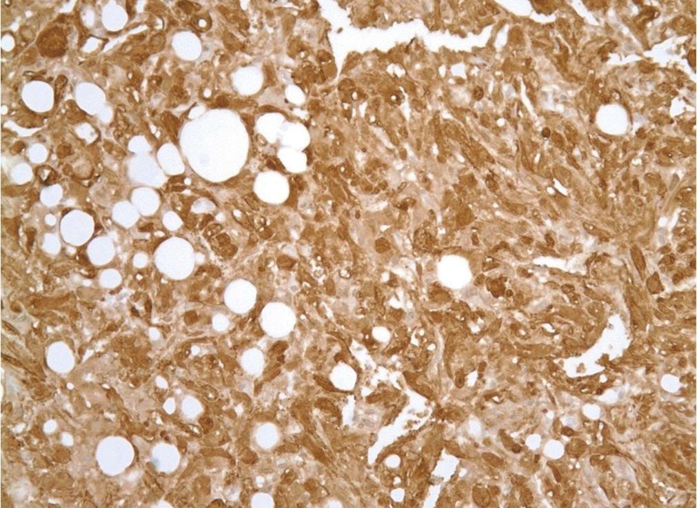 The mass in our over 30 months. case displayed the same pathological and immunohistochemical characteristics.