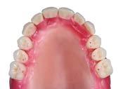 Setup of the anterior teeth in relation to the esthetic