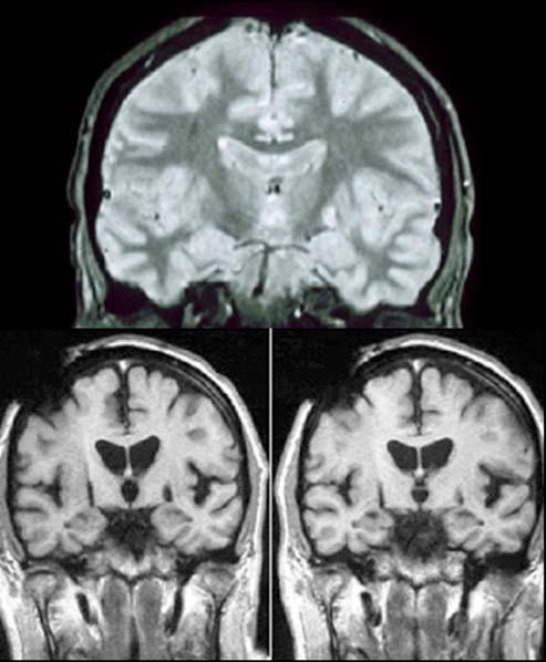 Cerebral Magnetic Resonance Imaging Feasibility in Patients The Open Magnetic Resonance Journal, 2008, Volume 1 5 On T1 (Fig. 3) and T2 (Fig.