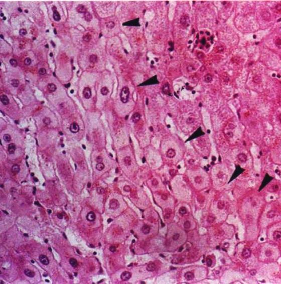 Tumorigenesis, besides HBx Type I GGHs Type II GGHs (H&E