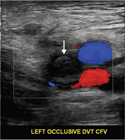 Case No 1 Duplex scanning revealed extensive DVT Admitted to hospital Renal function: WNL