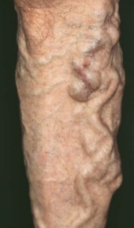 Case No 6 29 year old female with longstanding varicose veins.