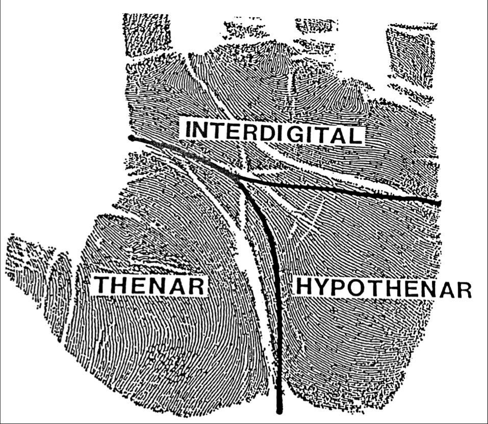 bottom of the little finger before it exits on the ulnar side of the palm (Ron Smith and Associates, 2002).