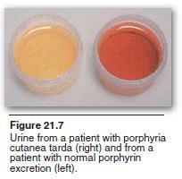 Porphyrias Porphyria refers to the purple color caused by pigment-like porphyrins in the urine of patients Rare,