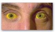 Jaundice Jaundice (or icterus) is the yellow color of skin, nail beds, and sclera due to