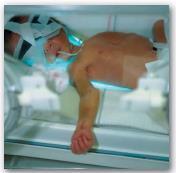 Jaundice in newborns Treatment: