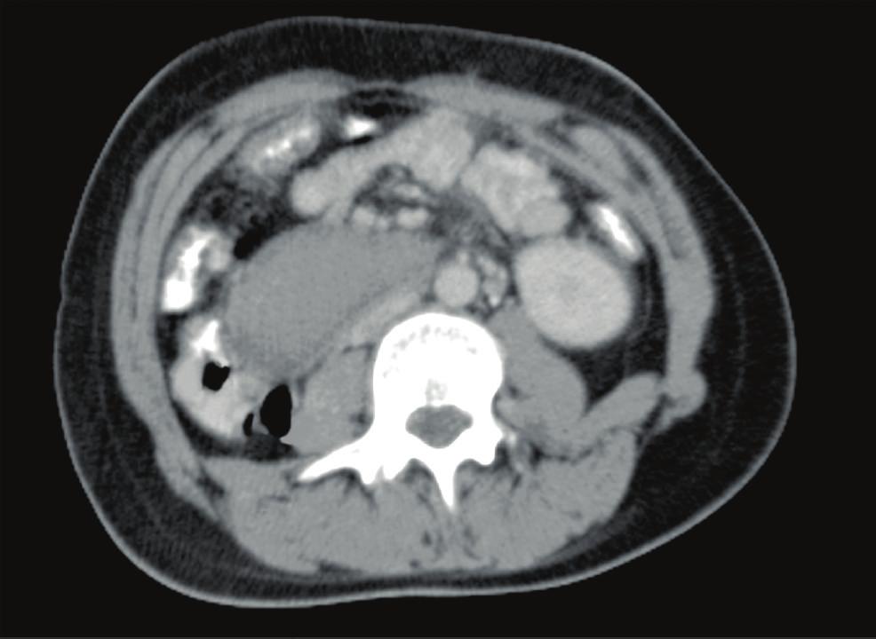 Case Reports in Surgery Figure 1: Oral and intravenous ontrast-enhaned CT san of the abdomen. The nonommuniating yst extends along the third portion of the duodenum (: yst).