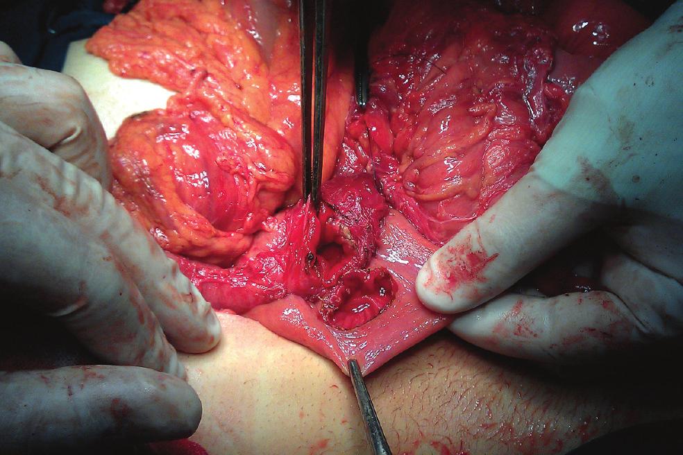 () The yst ollapsed after marsupialization and duodenojejunal anastomosis was performed (: yst, j: jejunum, numbers: orresponding parts of the duodenum).
