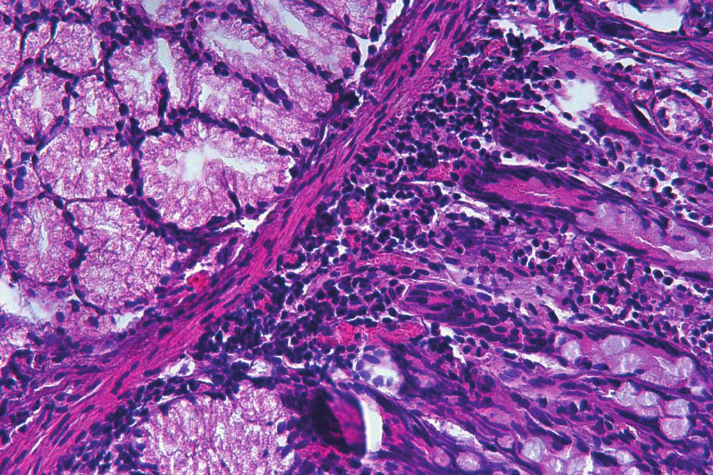 V MM Figure 3: Histologial view of the yst wall showing typial struture of duodenal muosa (hematoxylin and eosin, 100) (B: Brunner s glands, MM: muosa musularis, V: duodenal villi).