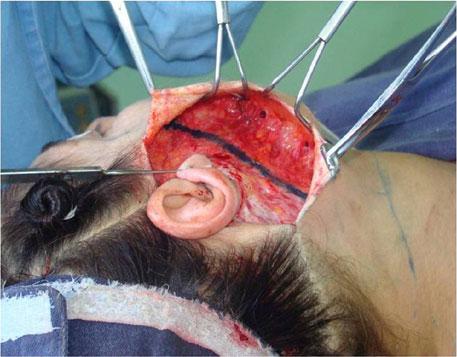 5 a, b Area of approximately 4 cm around the auricular pavilion undermined with scissors to allow SMAS plicature and excess skin resection The EUR as well as the conventional techniques demonstrated