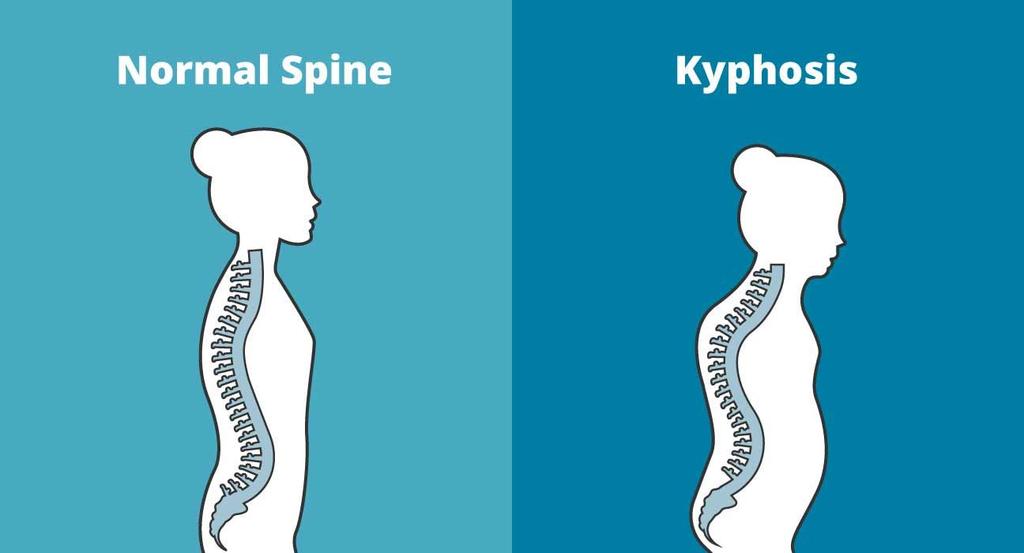 Anatomical Description Kyphosis is the term used to describe excessive curvature of the spine and can contribute to a hunchback appearance.