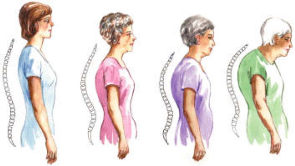 Kyphosis affects 20-40% of the aging population and may include a jutting chin, tight chest muscles, weak spinal extensors causing strain on the neck and a tucked pelvis when
