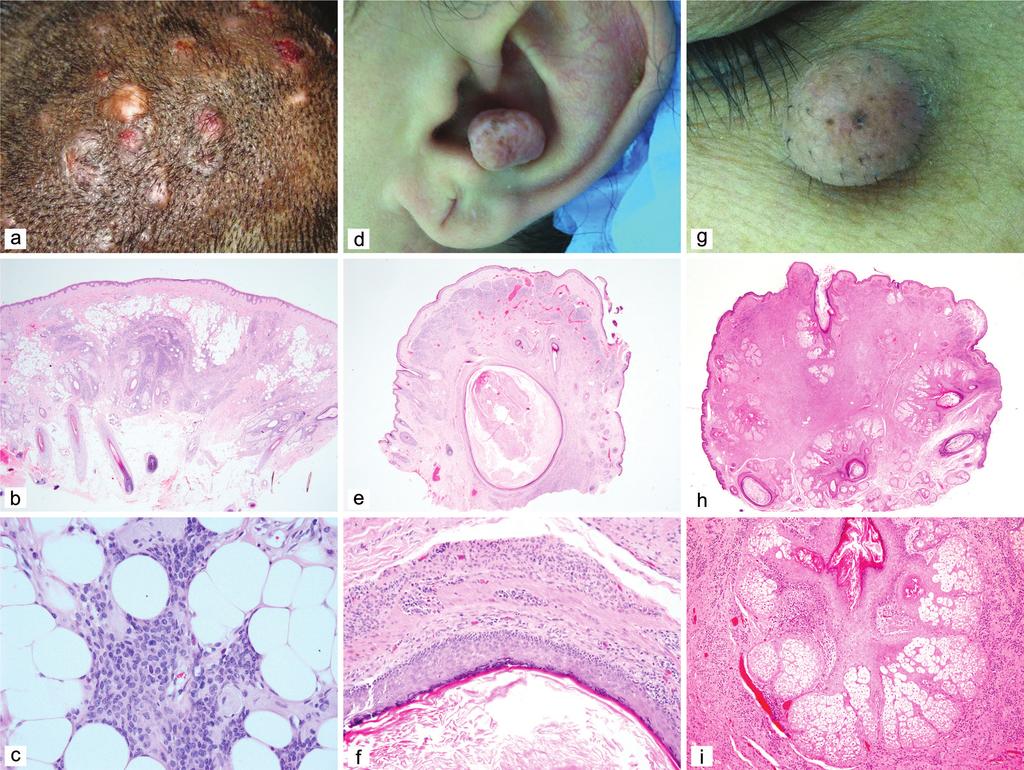 A clinicopathological study of melanocytic nevi Acta Dermatovenerol APA ;:- Table Clinical characteristics and histological spectrum of acquired melanocytic nevi in.