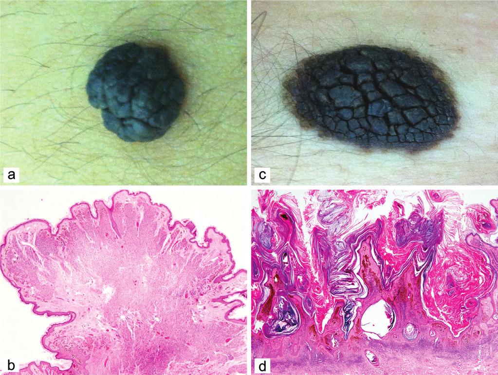 M. A. El-Khalawany Acta Dermatovenerol APA ;:- Figure Keratotic nevi presented with large pigmented lesions, either pedunculated nodule (a) or well-demarcated plaque (c).