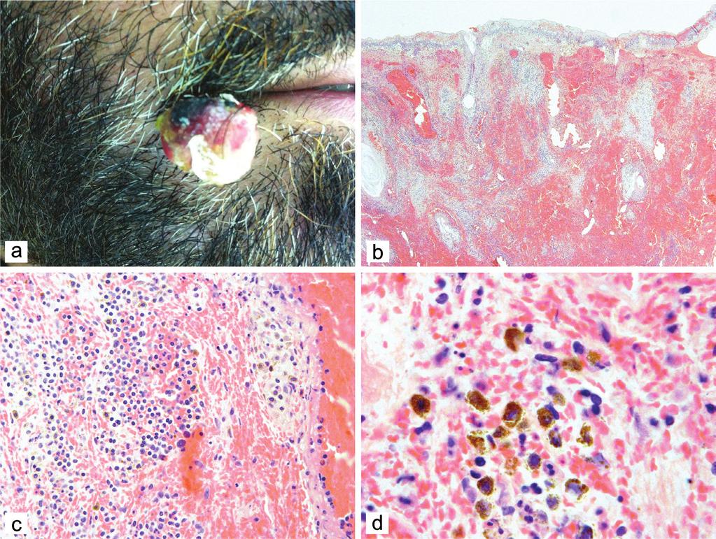 Figure Angiomatous nevus on the mouth angle (a) showed surface ulceration (b, HE ) with prominent hemorrhage (c, HE ) and mixed nevus cells with RBCs (d, HE,).