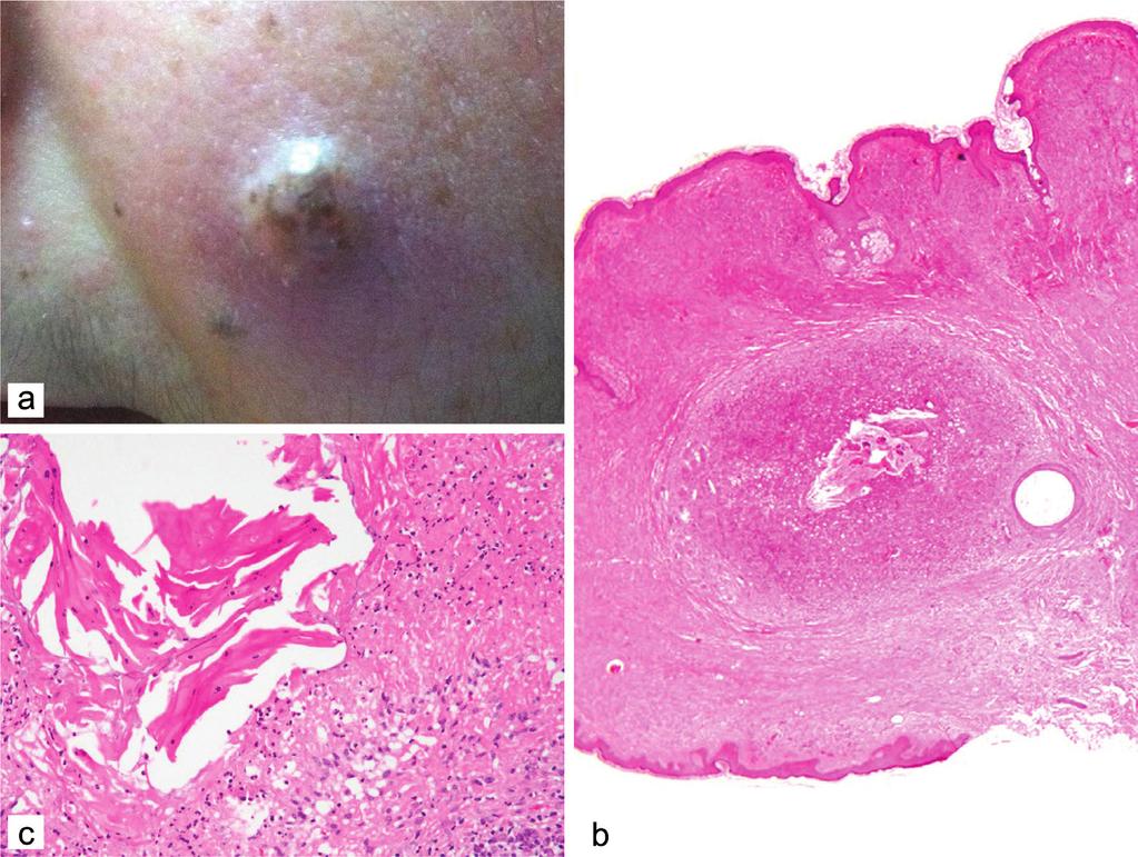 Acta Dermatovenerol APA ;:- A clinicopathological study of melanocytic nevi Figure Inflamed nevus on the cheek (a) showed ruptured hair follicle on the mid dermis (b, HE ) with mixed inflammatory