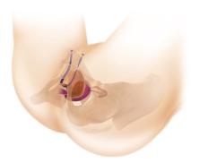 But first, it's important to know what type of urinary incontinence do I have?